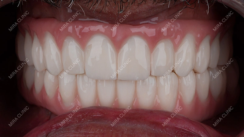 Full-Arch Treatment